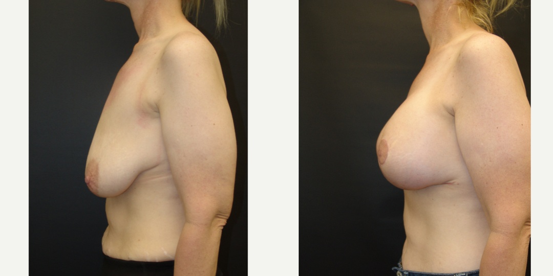 Woman treated with Breast Lift With Implants