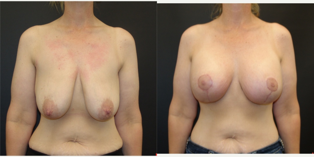 Woman treated with Breast Lift With Implants