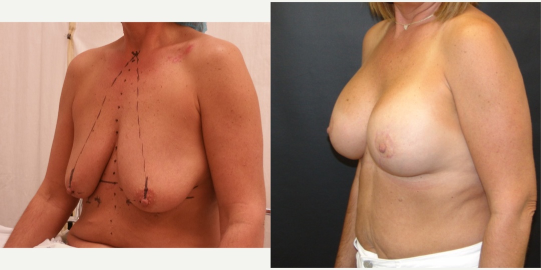 Woman treated with Breast Lift With Implants