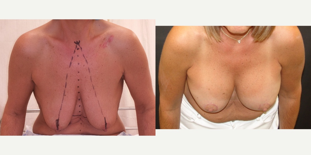 Woman treated with Breast Lift With Implants
