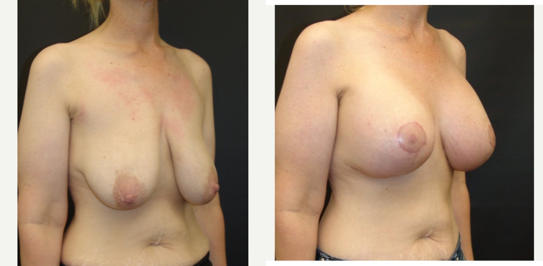 Woman treated with Breast Lift With Implants