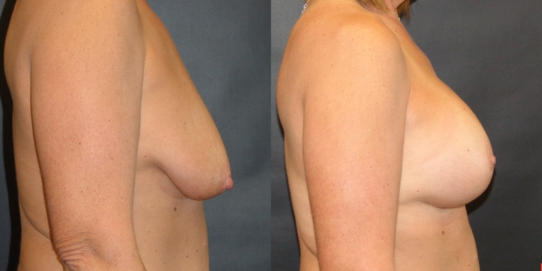 Woman treated with Breast Lift With Implants