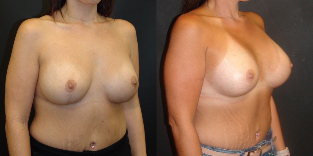 Woman treated with Breast Lift With Implants