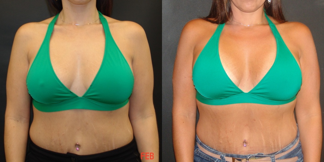 Woman treated with Breast Lift With Implants