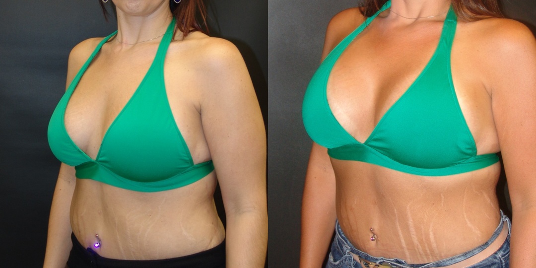 Woman treated with Breast Lift With Implants