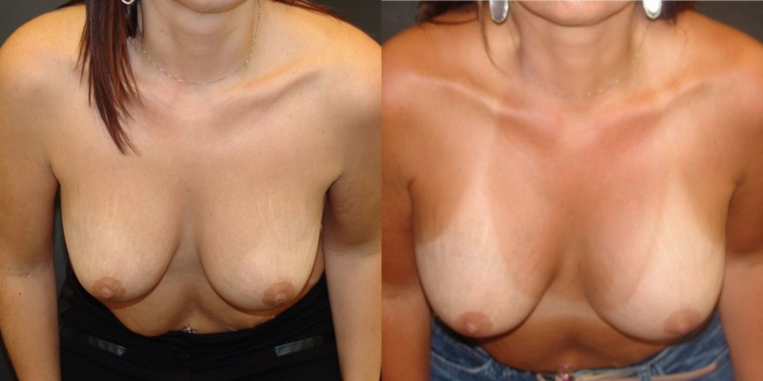 Woman treated with Breast Lift With Implants