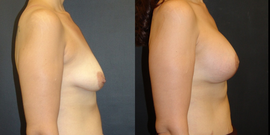 Woman treated with Breast Lift With Implants