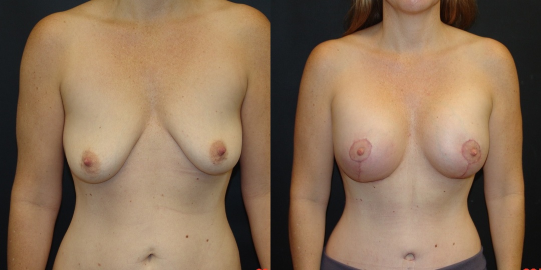 Woman treated with Breast Lift With Implants