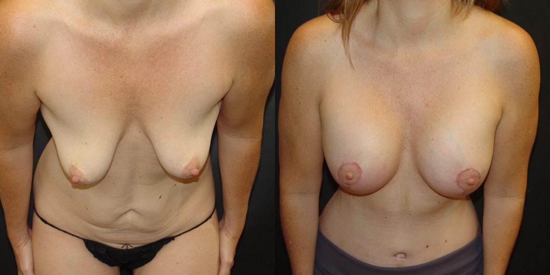 Woman treated with Breast Lift With Implants