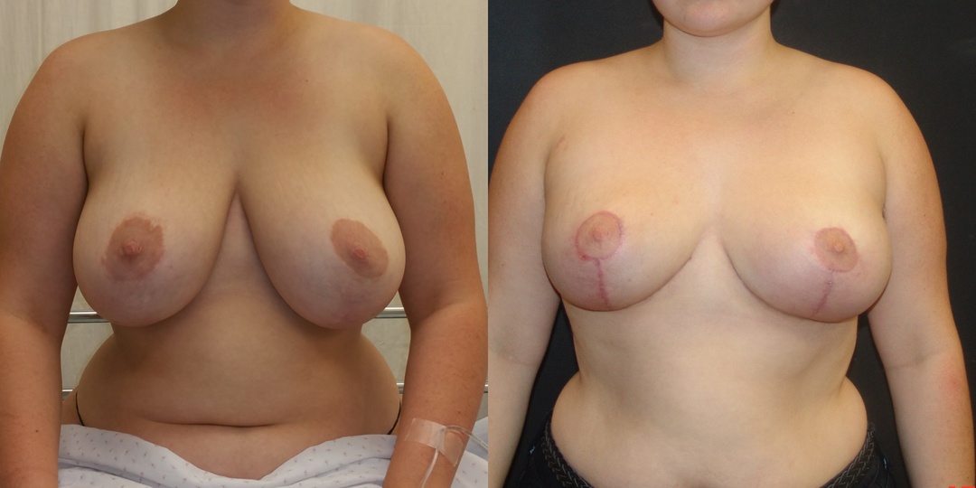 Woman treated with Breast Lift