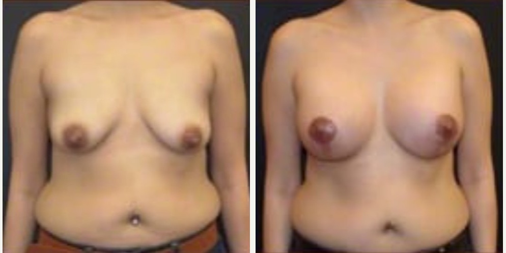Woman treated with Breast Lift