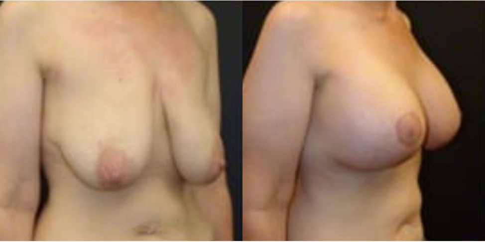 Woman treated with Breast Lift