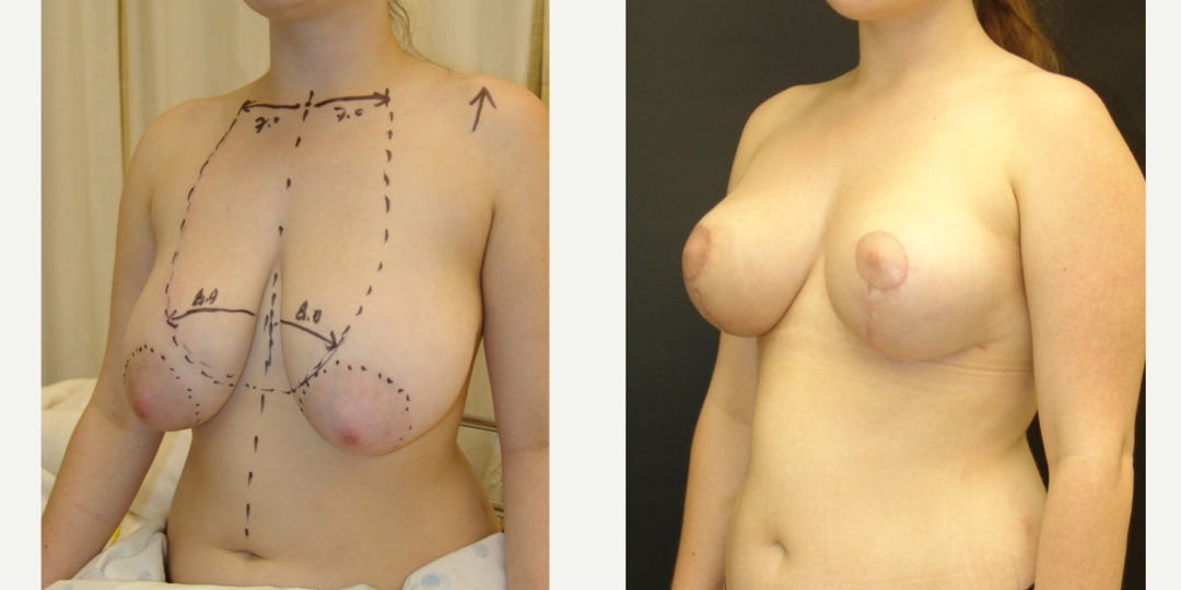Woman treated with Breast Reduction