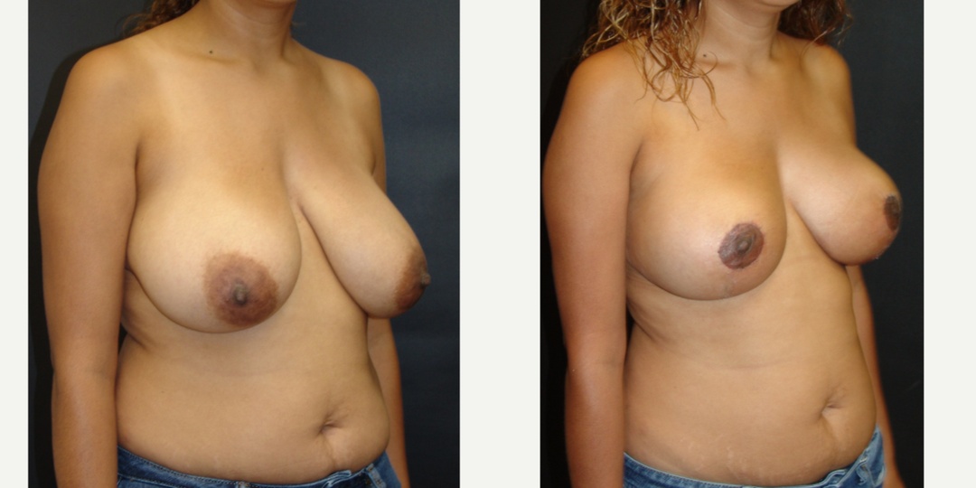 Woman treated with Breast Reduction