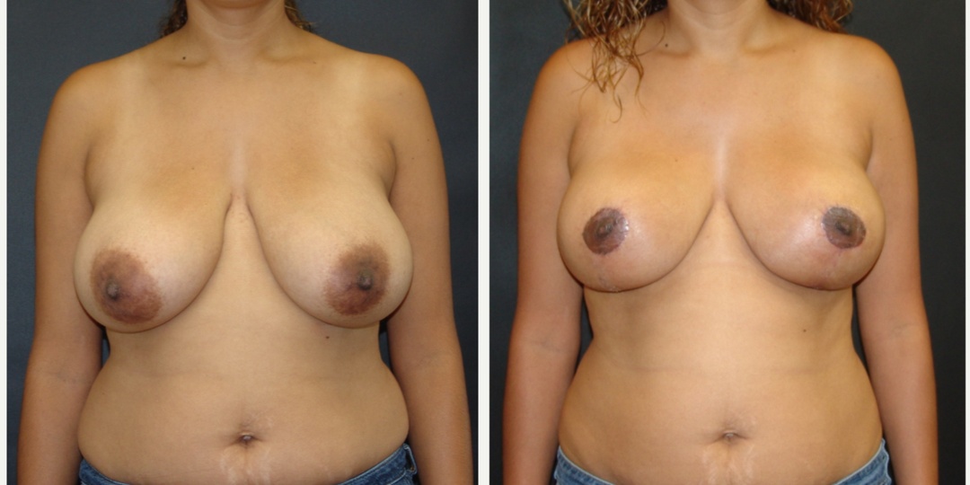 Woman treated with Breast Reduction