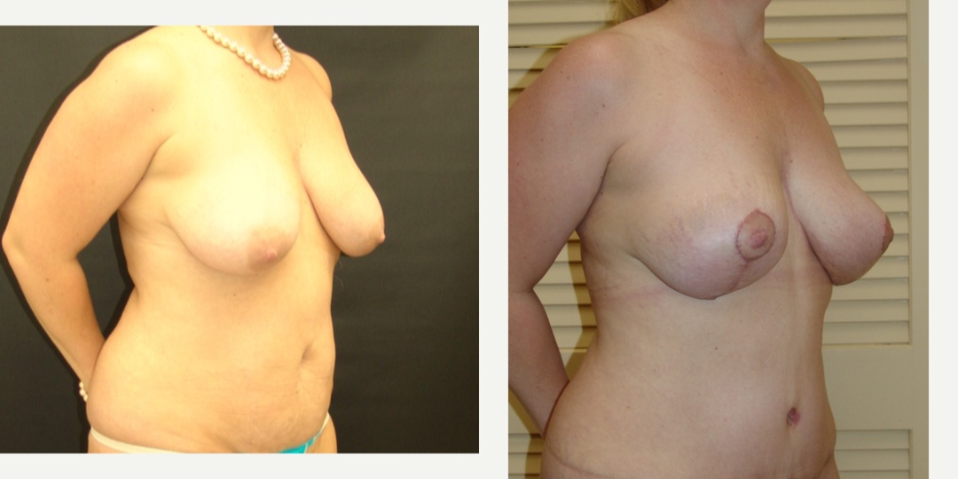 Woman treated with Breast Reduction