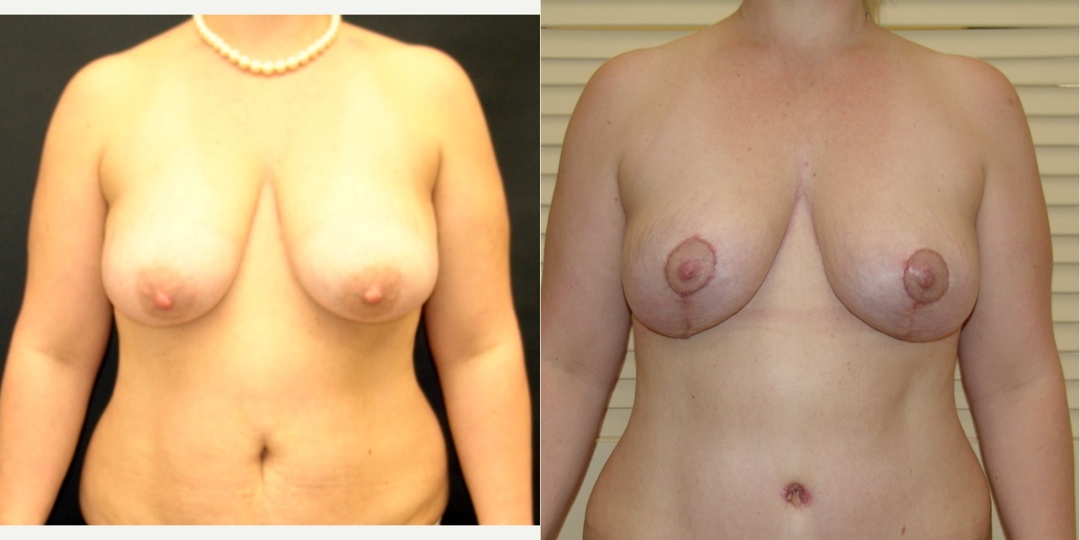 Woman treated with Breast Reduction