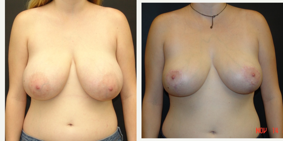 Woman treated with Breast Reduction