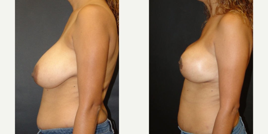 Woman treated with Breast Reduction
