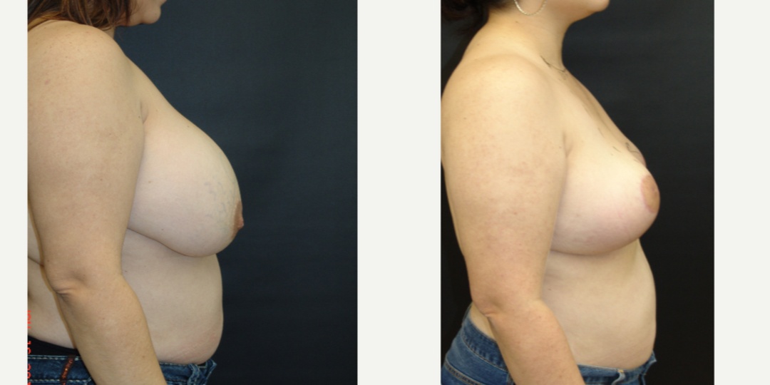 Woman treated with Breast Reduction