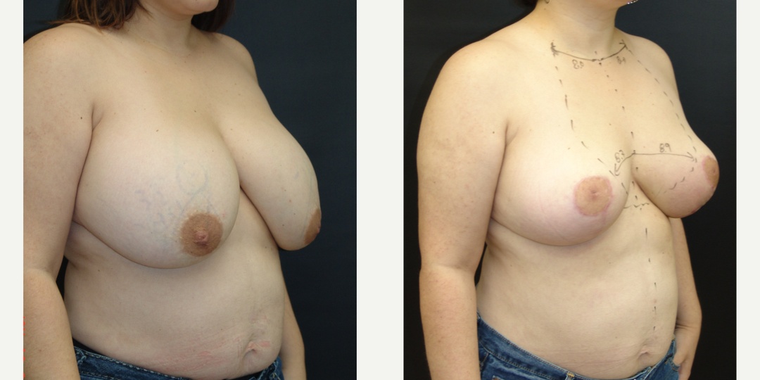 Woman treated with Breast Reduction