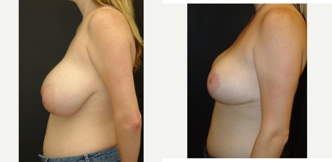 Woman treated with Breast Reduction