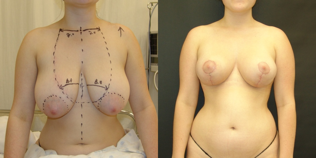 Woman treated with Breast Reduction