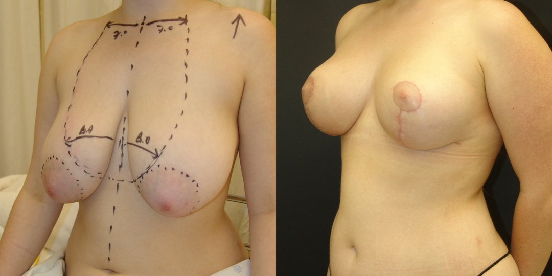 Woman treated with Breast Reduction