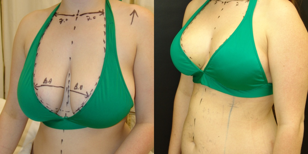 Woman treated with Breast Reduction