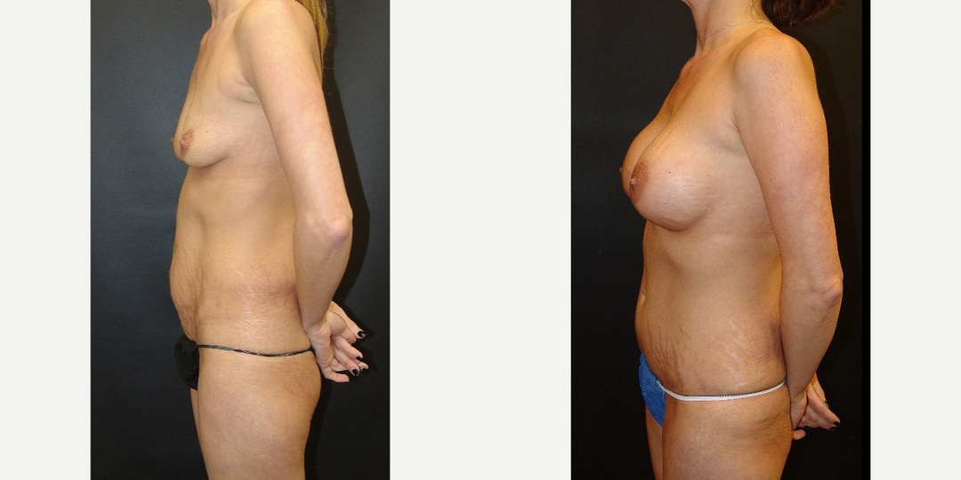 Woman treated with Mommy Makeover