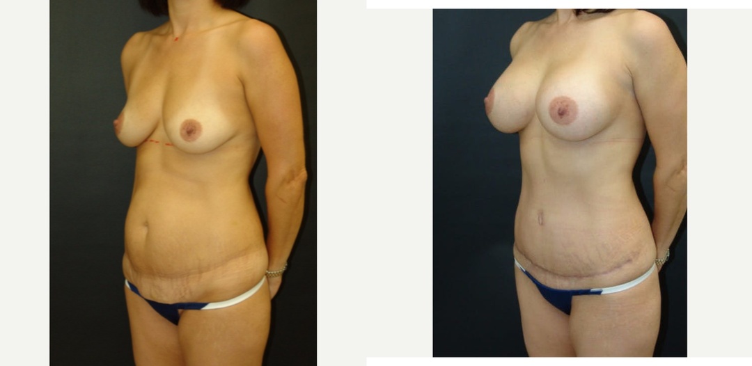 Woman treated with Mommy Makeover