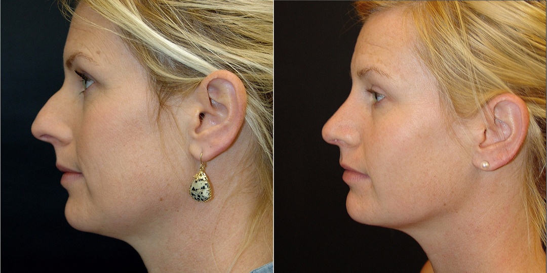 Woman treated with Rhinoplasty