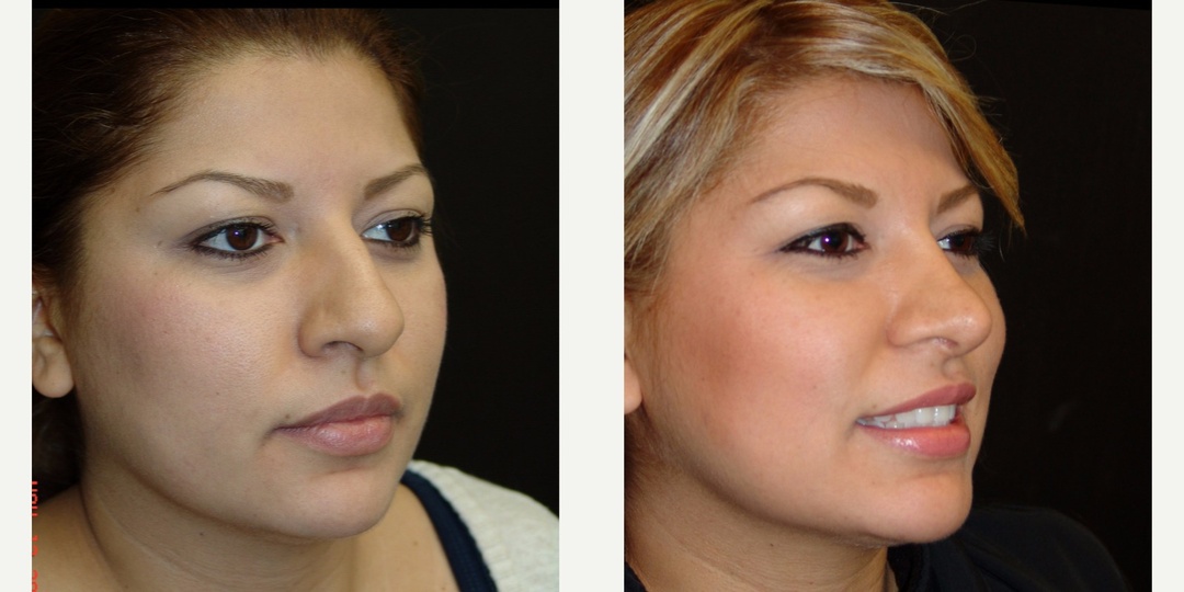 Woman treated with Rhinoplasty
