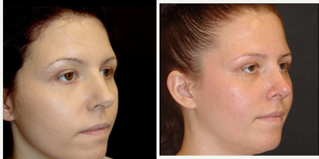 Woman treated with Rhinoplasty