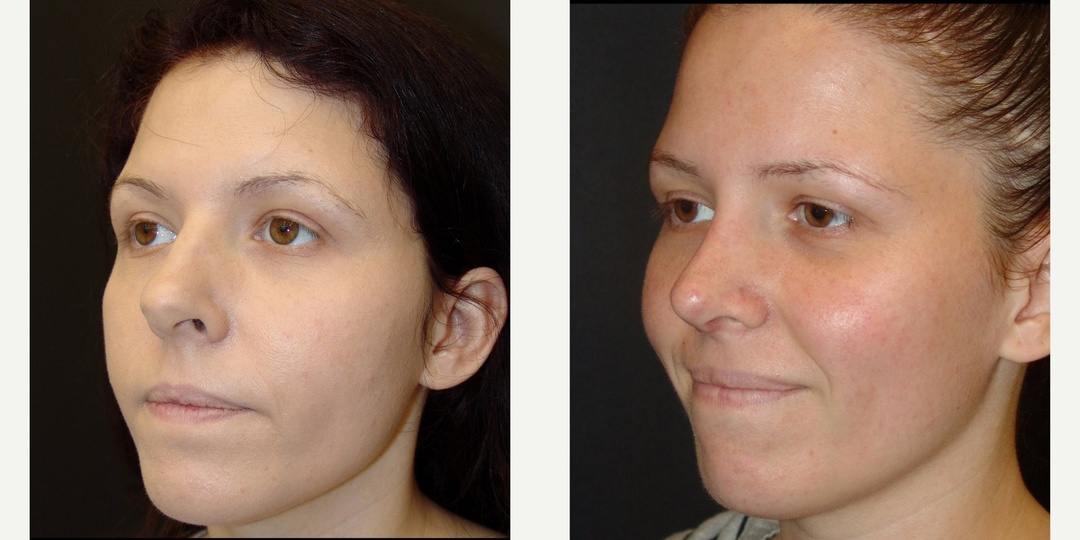 Woman treated with Rhinoplasty