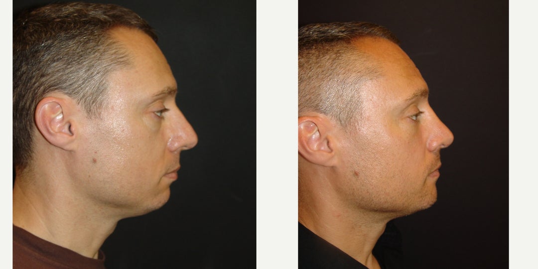 Woman treated with Rhinoplasty