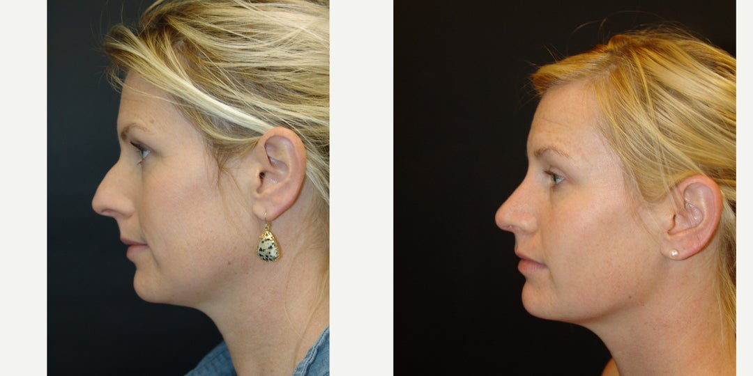 Woman treated with Rhinoplasty