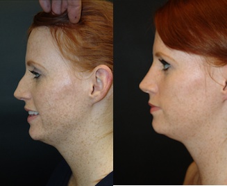 Woman treated with Rhinoplasty