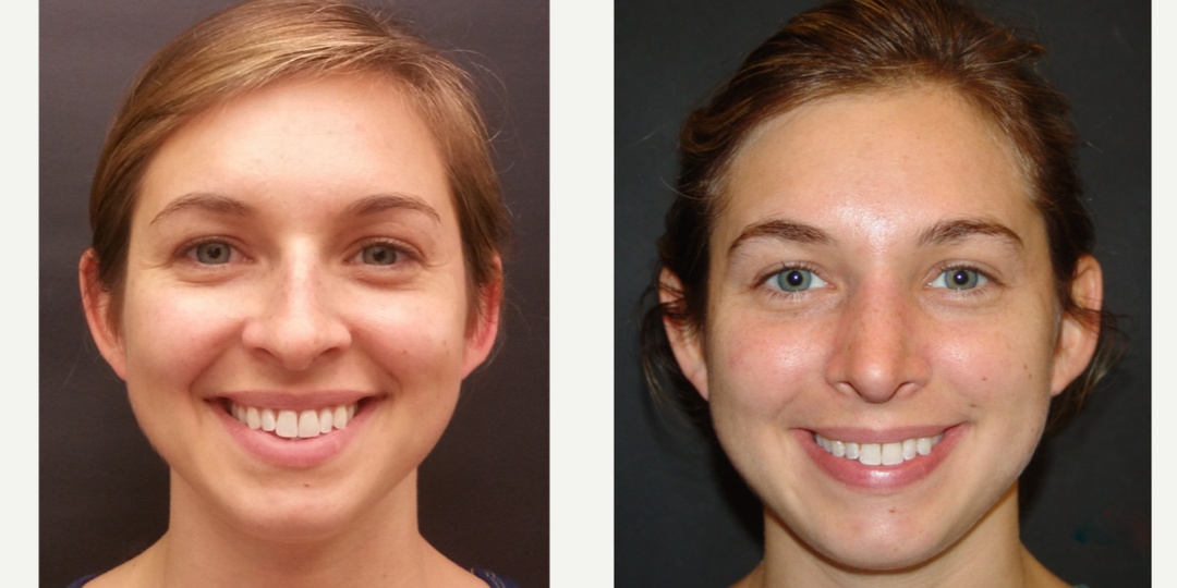 Woman treated with Rhinoplasty