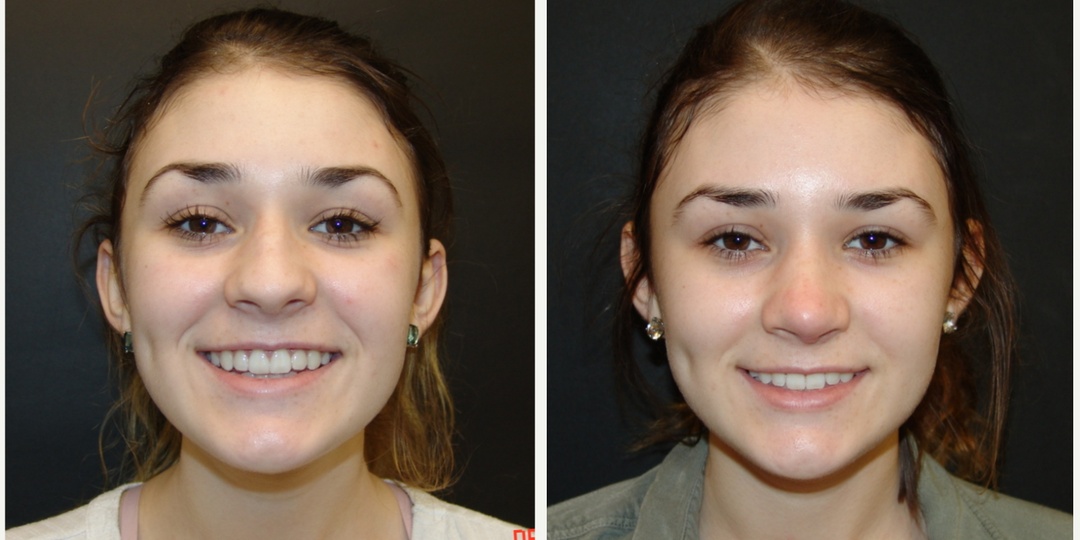 Woman treated with Rhinoplasty