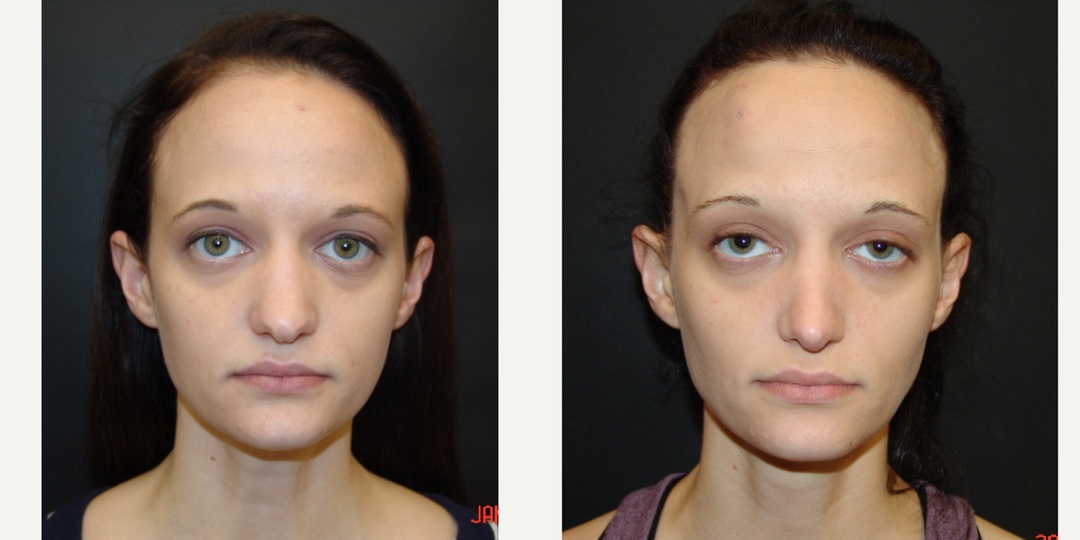 Woman treated with Rhinoplasty