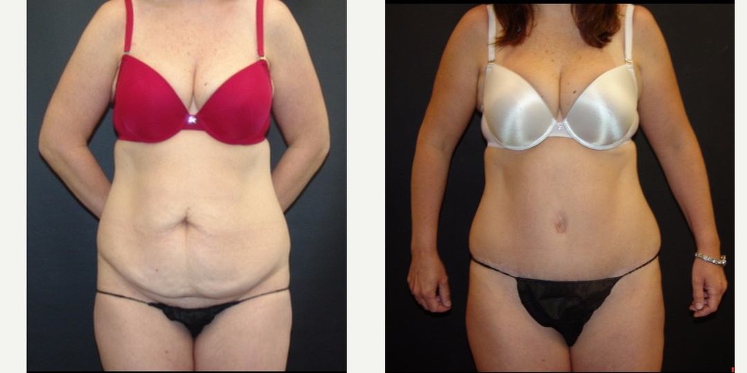Woman treated with Tummy Tuck