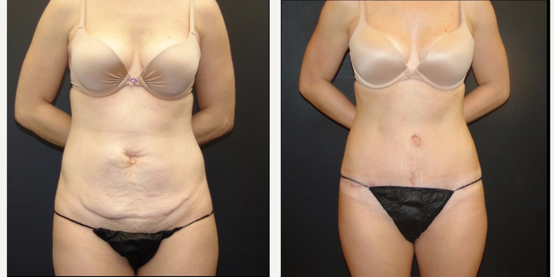 Woman treated with Tummy Tuck