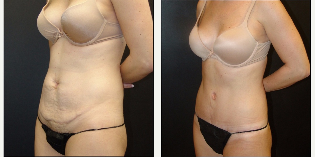 Woman treated with Tummy Tuck