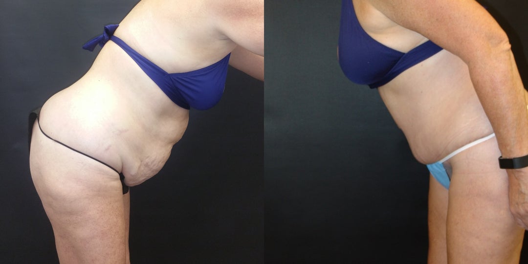 Woman treated with Tummy Tuck