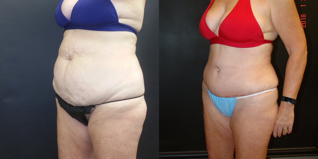 Woman treated with Tummy Tuck