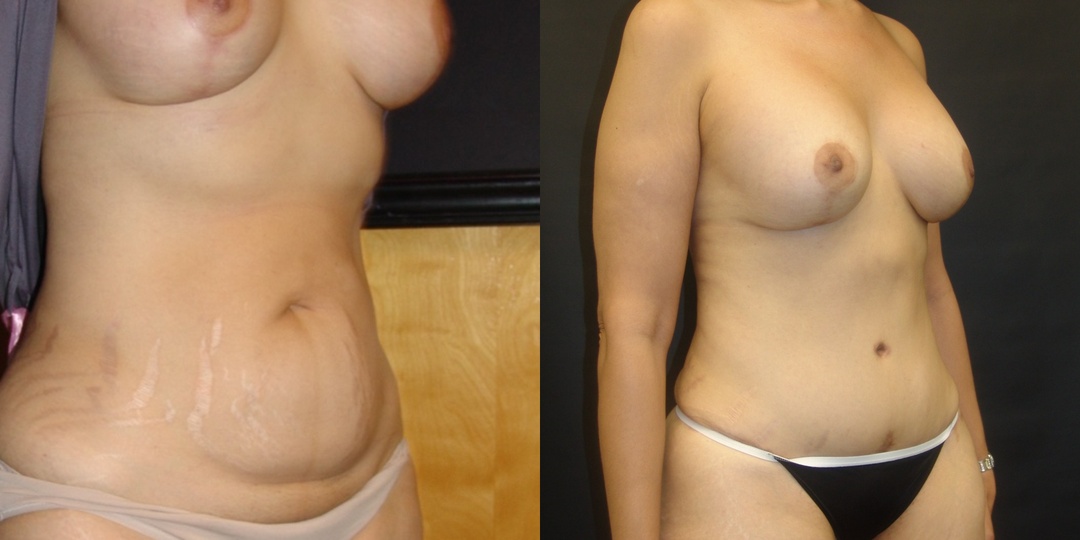 Woman treated with Tummy Tuck