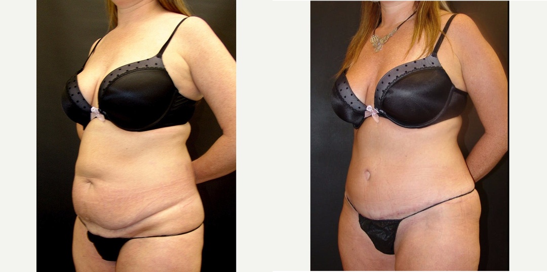 Woman treated with Tummy Tuck