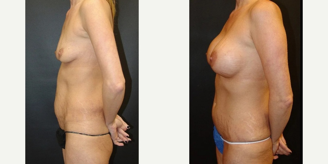 Woman treated with Tummy Tuck