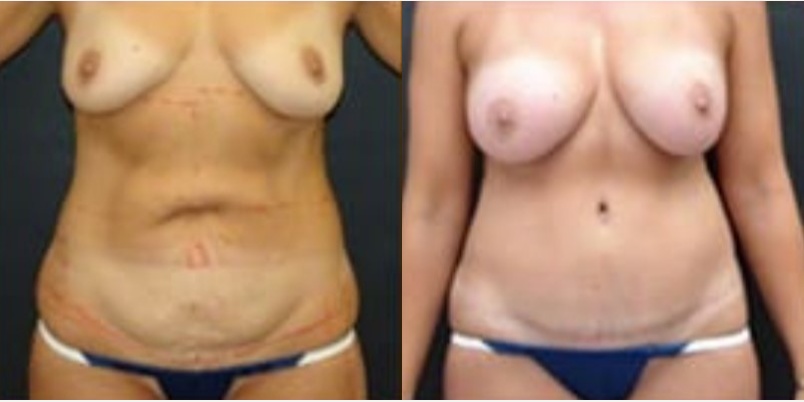 Woman treated with Tummy Tuck